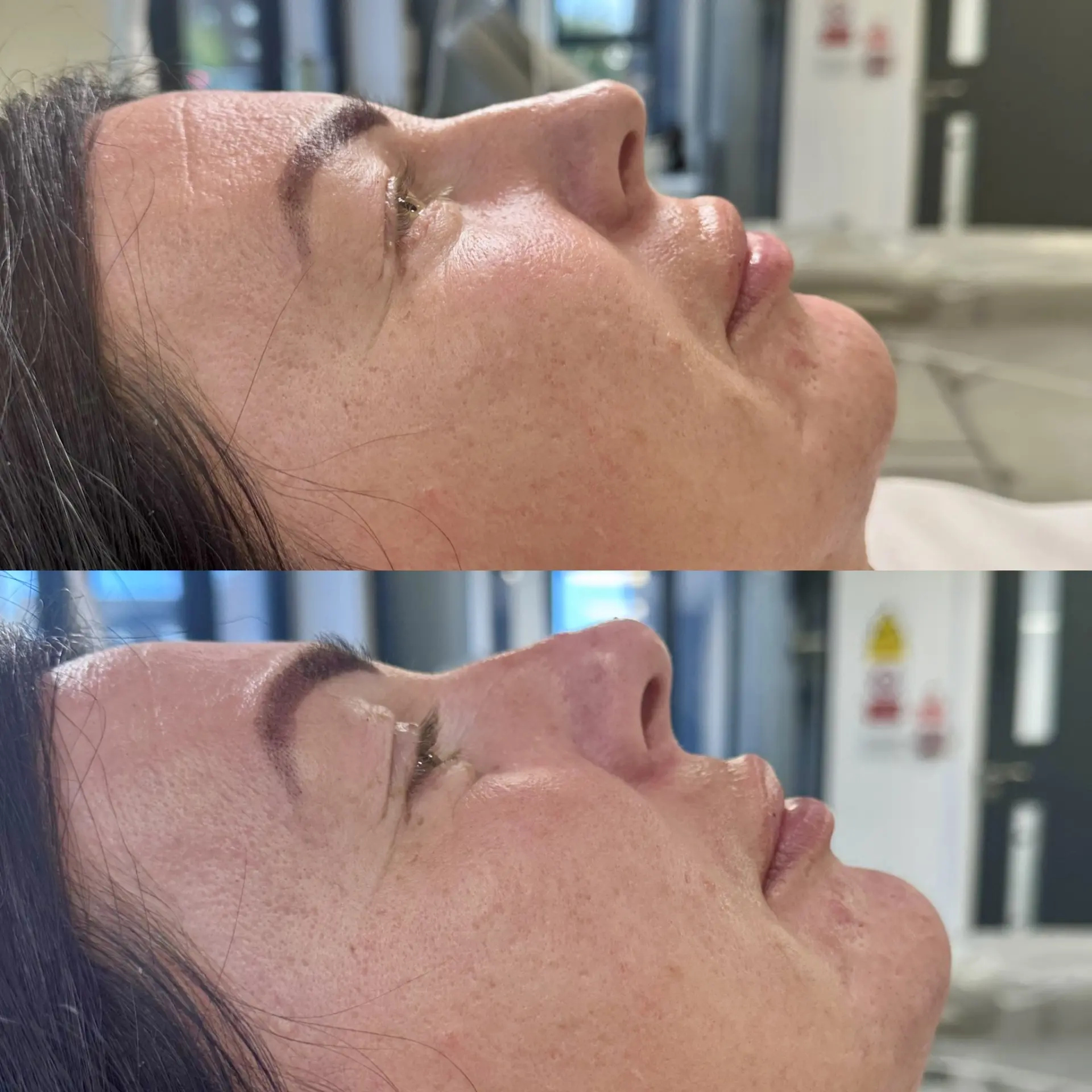 Before and after result — Nose filler / liquid rhinoplasty at The Aesthetics Shed