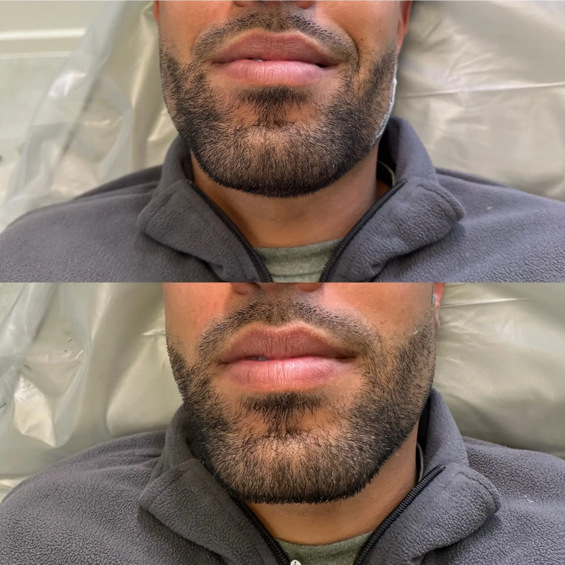 Before and after result — Dermal filler · jawline enhancement at The Aesthetics Shed